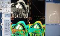 راه اندازي تكنيك تصويربرداري MRI T2 star در زاهدان